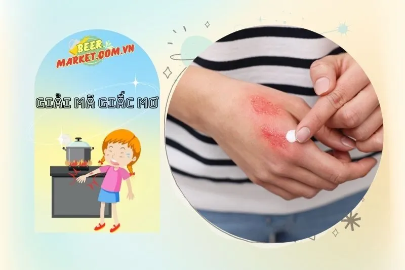 Lời khuyên khi nằm mơ thấy bị bỏng