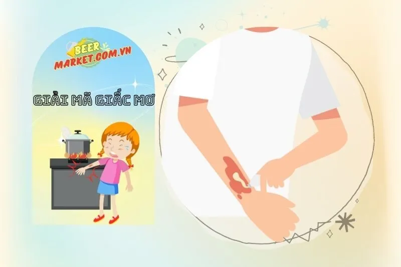 Mơ thấy người thân bị bỏng